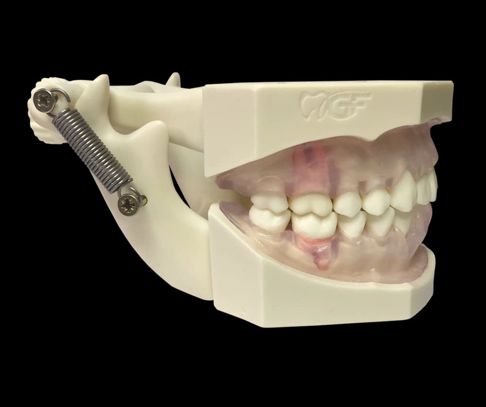 Burnos higienisto modelis su hipertrofinėmis dantenomis - oficiali GF Dental produkto nuotrauka