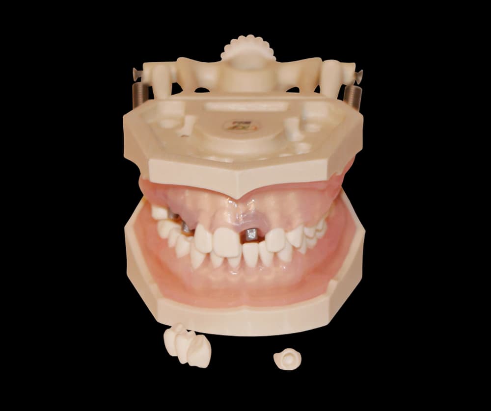 Burnos higienos modelis su implantais - oficiali GF Dental produkto nuotrauka