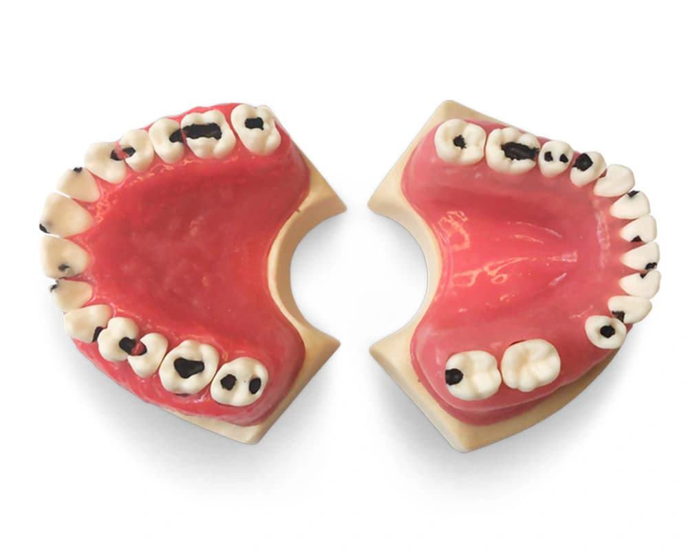Modelis su periodontito pažeistomis dantenomis E826 - oficiali GF Dental produkto nuotrauka