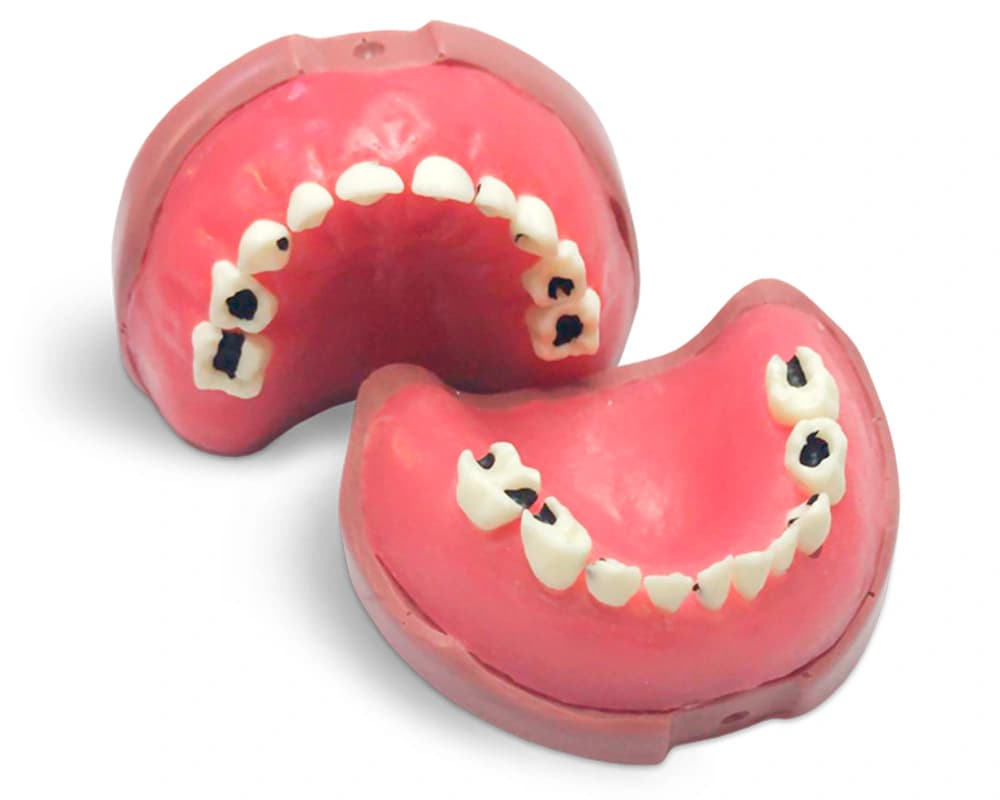 Vaiko modelis su ėduonies pažeistu pieniniu sąkandžiu EK5 - oficiali GF Dental produkto nuotrauka
