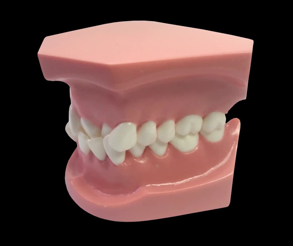 Ortodontinis modelis su priekinių dantų susigrūdimu - oficiali GF Dental produkto nuotrauka