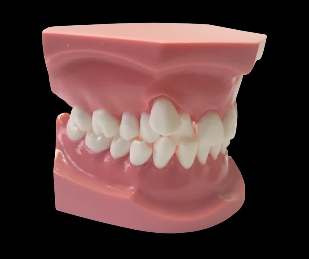 Ortodontinis modelis su ektopiškai dygstančia iltimi - oficiali GF Dental produkto nuotrauka