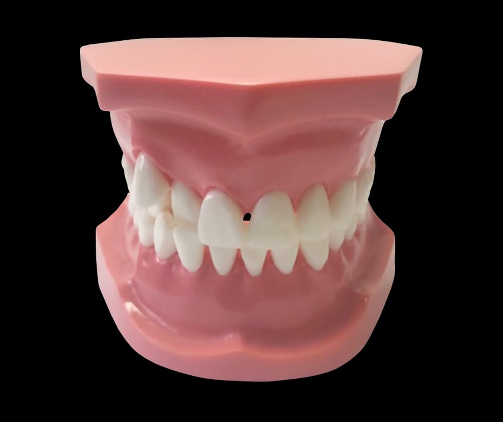 Ortodontinis modelis su ektopiškai dygstančia iltimi - oficiali GF Dental produkto nuotrauka