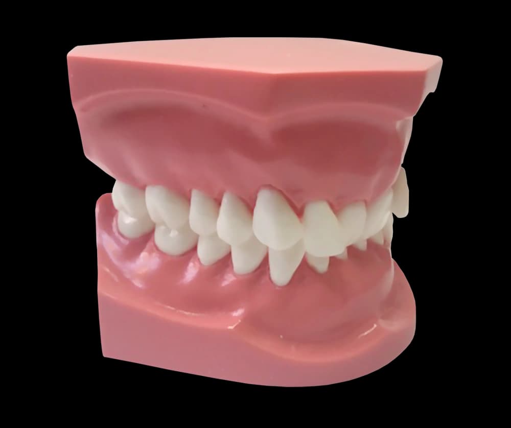 II klasės 2 poklasio ortodontinis modelis - oficiali GF Dental produkto nuotrauka