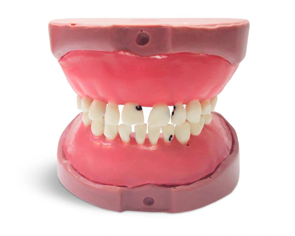Vaiko modelis su ėduonies pažeistu pieniniu sąkandžiu EK5 - oficiali GF Dental produkto nuotrauka
